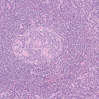 Castleman’s disease (hyaline vascular型)